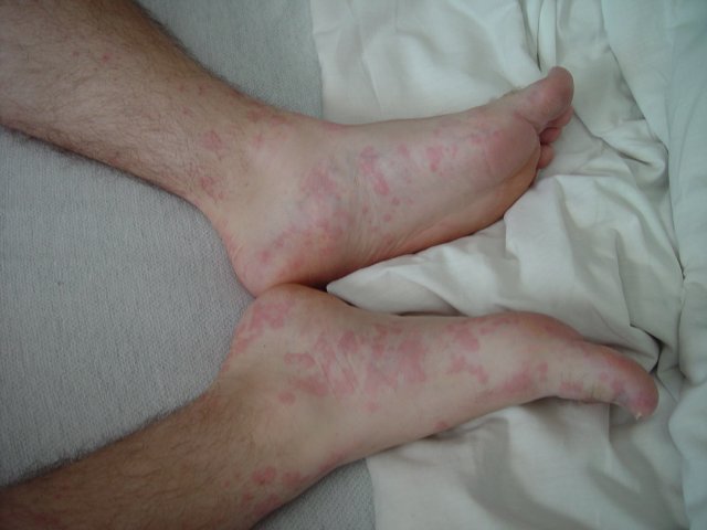 xanax to allergic reactions