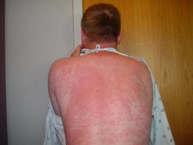 doxycycline allergic reaction - JasperMcgill1's blog